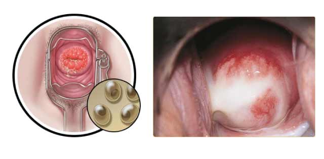 Bệnh lây qua đường tình dục Chlamydia là bệnh gì? Nguyên nhân, triệu chứng,  cách phòng tránh | Vinmec